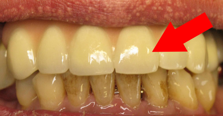 Дружина стоматолога поділилася секретами відбілювання зубів: 4 хвилини і зубного каменю наче й не було!