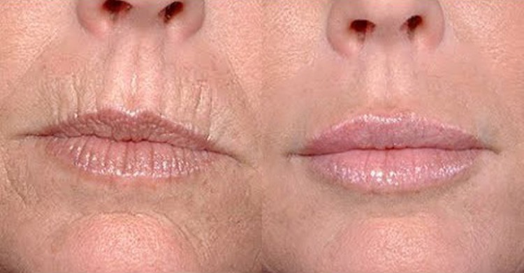 Як легко позбутися від глибоких зморшок навколо рота: 5 простих масок, які творять чудеса зі старіючої шкірою!