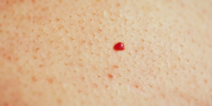 Червоні плями на шкірі: чи варто хвилюватися?