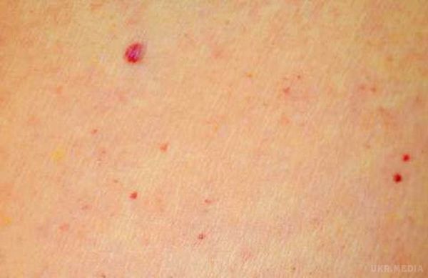 Червоні цятки на шкірі: захворювання чи косметичний дефект?