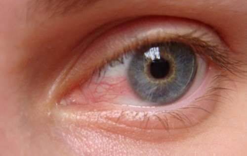 Червоні очі: як позбутися почервоніння за допомогою простих домашніх засобів