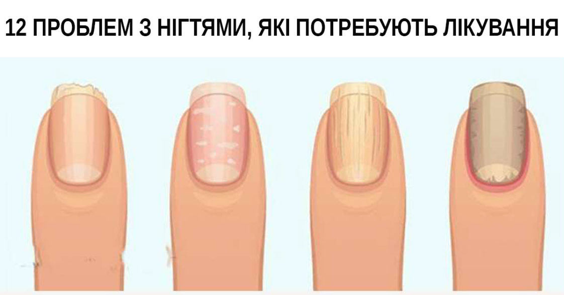 Якщо ви замітите ці зміни на своїх нігтях. Негайно до лікаря