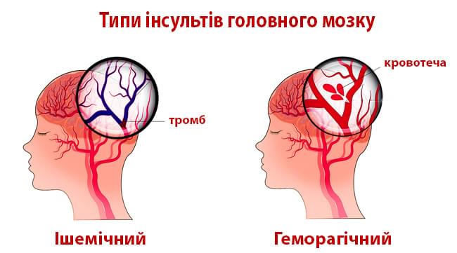 Інсульт – це не завжди крововилив: види інсульту та мікроінсульт