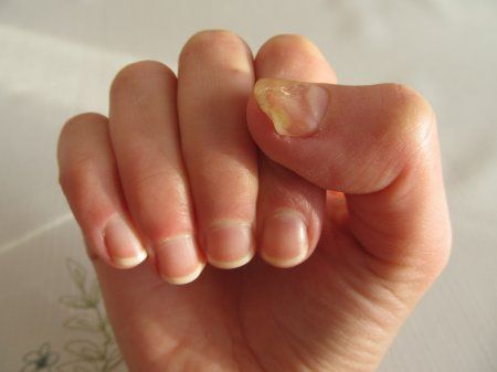Що таке грибок нігтів і як з ним можна боротися, не використовуючи дорогі засоби?